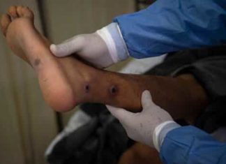 WHO: Global monkeypox cases drop 21%, reversing month-long increase | Mint – Mint
