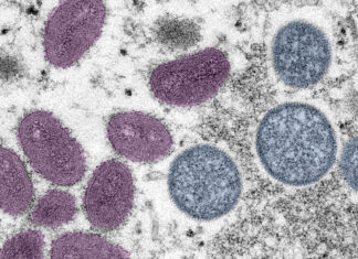 2022 Outbreak Cases and Data | Monkeypox | Poxvirus | CDC – CDC