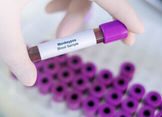 Experts say elimination of monkeypox possible but containment still a challenge – KMAland