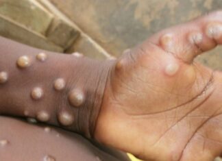 Experts: Surveillance of monkeypox cases can be strengthened by screening at-risk groups – The Indian Express