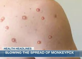 Health Headlines: Slowing the spread of Monkeypox – KPLC