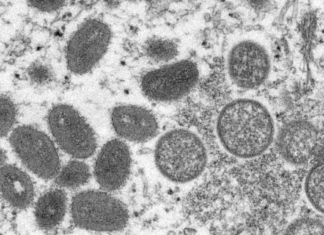 Health Officials Report Death Possibly Tied To Monkeypox In LA – LAist