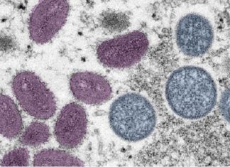 LA County Health Dept., CDC Confirm First Death in County Due to Monkeypox – Pasadena Now – Pasadena Now