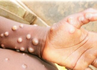 ‘Man on man’ sex inflicted virus is no monkey business – Graphic Online