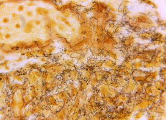 ‘Out of control’ STD situation prompts call for changes – The Associated Press