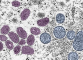 Questions about monkeypox answered by Ingham County Health Department – The State News