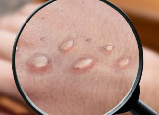 Smart Health: Making Sense of Monkeypox – outsmartmagazine.com