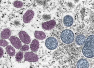 Monkeypox cases are in sharp decline. Could the outbreak be over? – Virginia Mercury