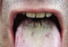 These tongue and mouth changes could be a sign of HIV - health.com