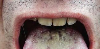 These tongue and mouth changes could be a sign of HIV - health.com