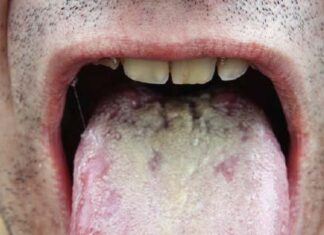 These tongue and mouth changes could be a sign of HIV - health.com