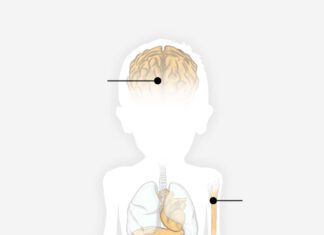 For Gaza's Children, Acute Malnutrition Could Cause a Lifetime of Health Challenges - The New York Times