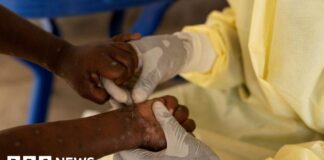What is Mpox and which EU countries are seeing increased cases? - BBC