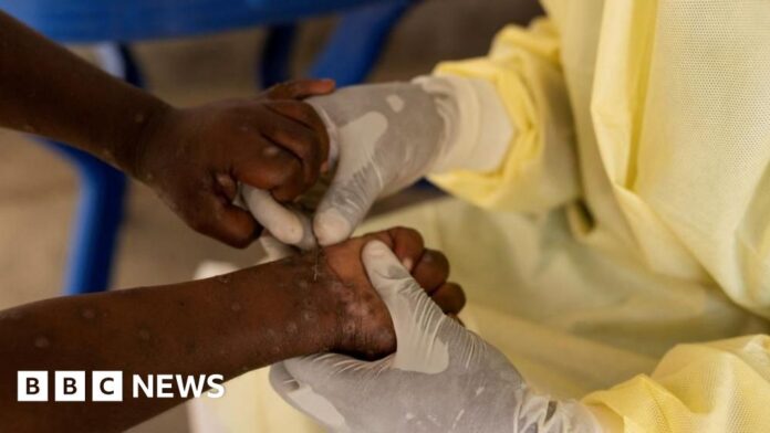 What is Mpox and which EU countries are seeing increased cases? - BBC