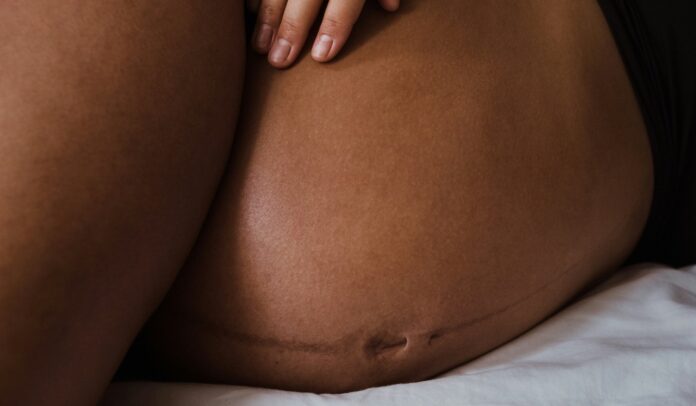 Why lesbians face a maternal healthcare crisis - Gay Times